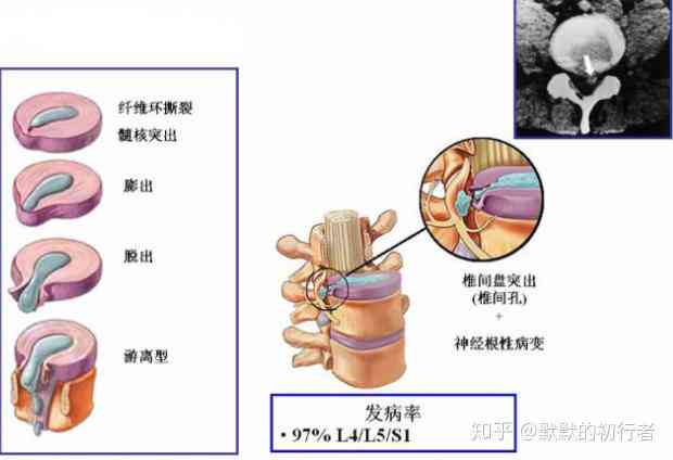 腰椎间盘突出已认定工伤