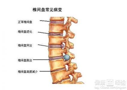 腰椎间盘膨出可认定工伤吗