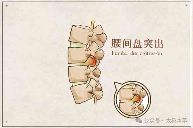 腰椎间盘膨出可认定工伤吗