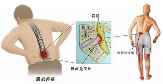 腰椎间盘膨出可认定工伤吗