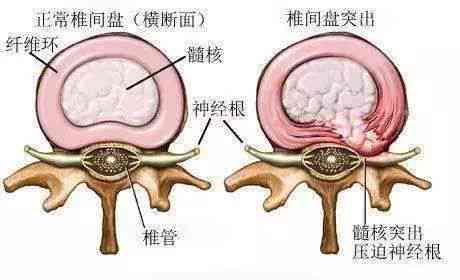 腰椎间盘膨出可认定工伤吗