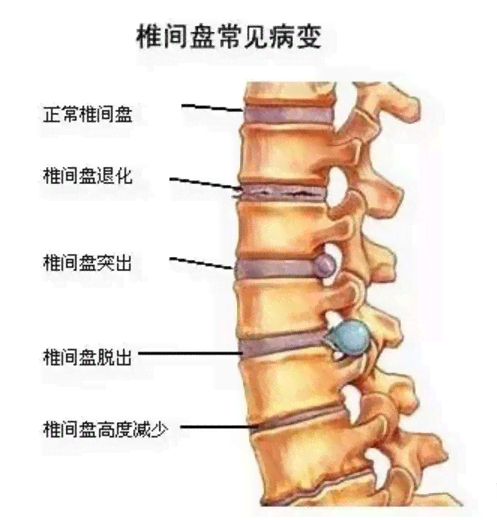 腰椎间盘膨出可认定工伤吗