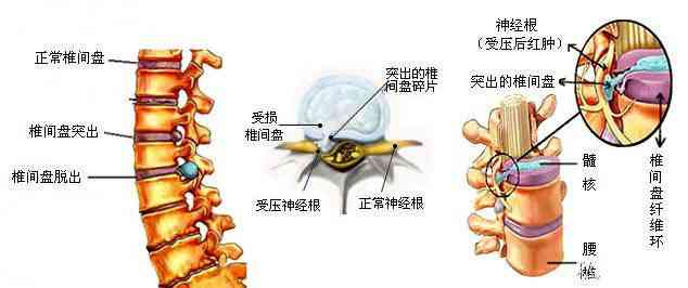 腰椎间盘膨出可认定工伤吗