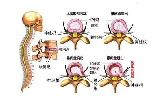 腰椎间盘膨出能认定工伤吗