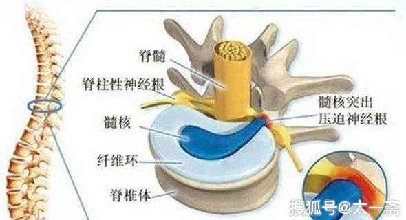 腰椎间盘膨出认定工伤