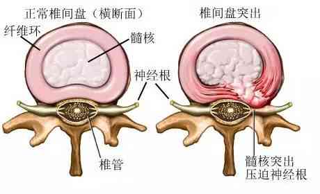 腰椎间突出能认定工伤吗