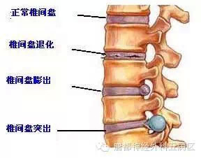 腰椎间突出能认定工伤吗