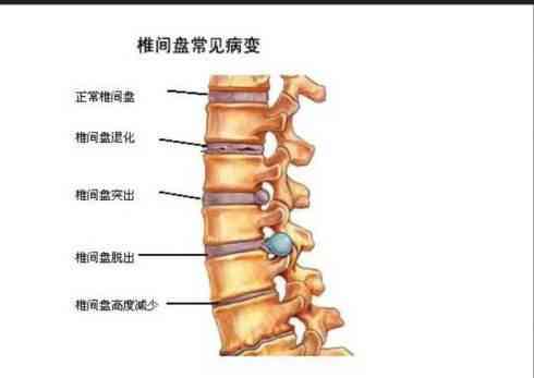 腰间盘突出症能认定工伤