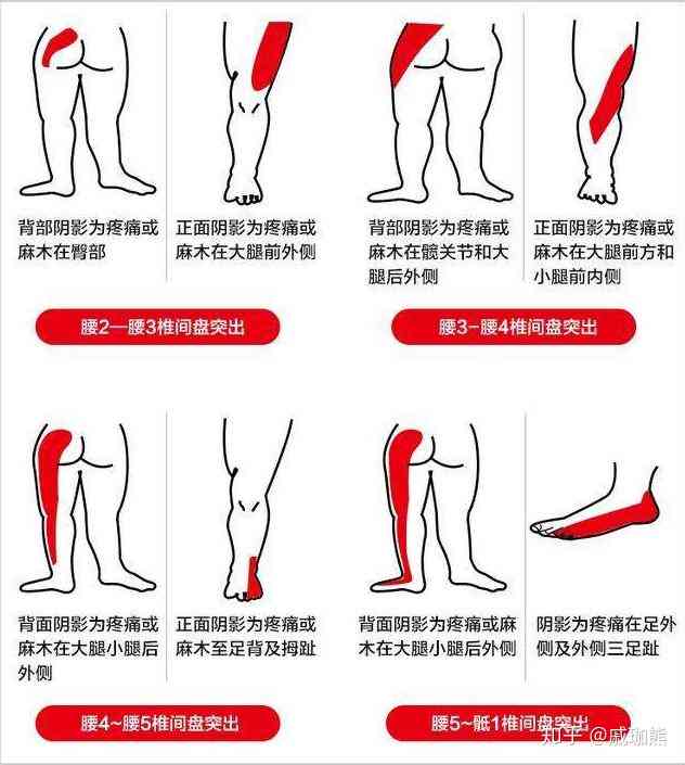 腰间盘突出能不能认定工伤