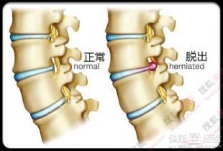 腰间盘突出能认定工伤么