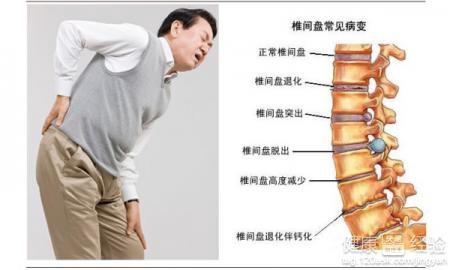 腰间盘突出能认定工伤么