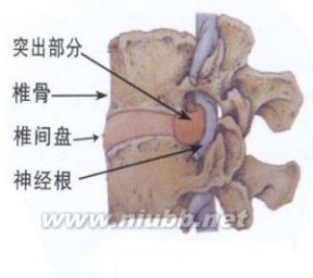 腰间盘突出能认定工伤吗