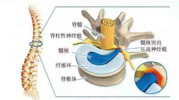 腰间盘突出能认定工伤吗