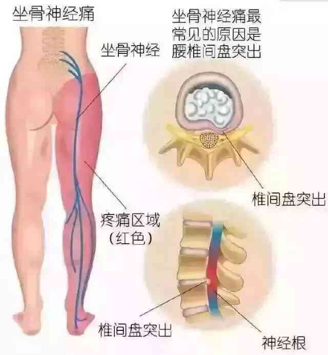 腰间盘突出认定工伤吗