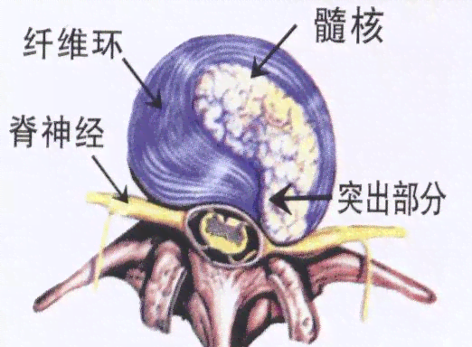 腰间盘脱出可以认定工伤吗