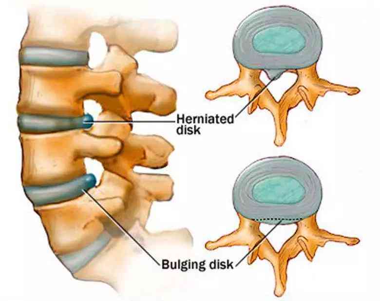腰间盘膨出怎么去认定工伤