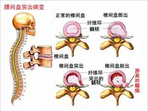 腰间盘膨出怎么去认定工伤