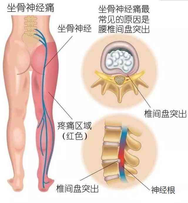 腰间盘膨出怎么去认定工伤