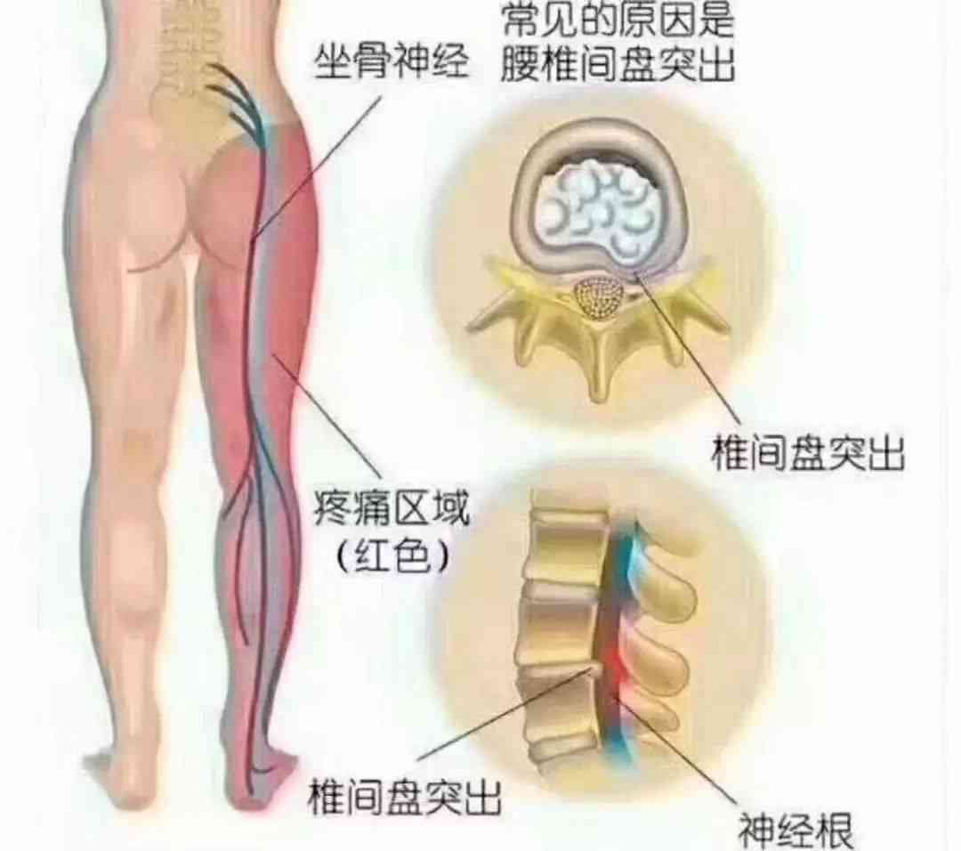 腰骨盘突出不认定工伤