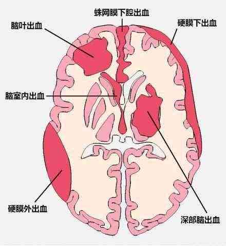 蛛网膜出血可以认定工伤吗