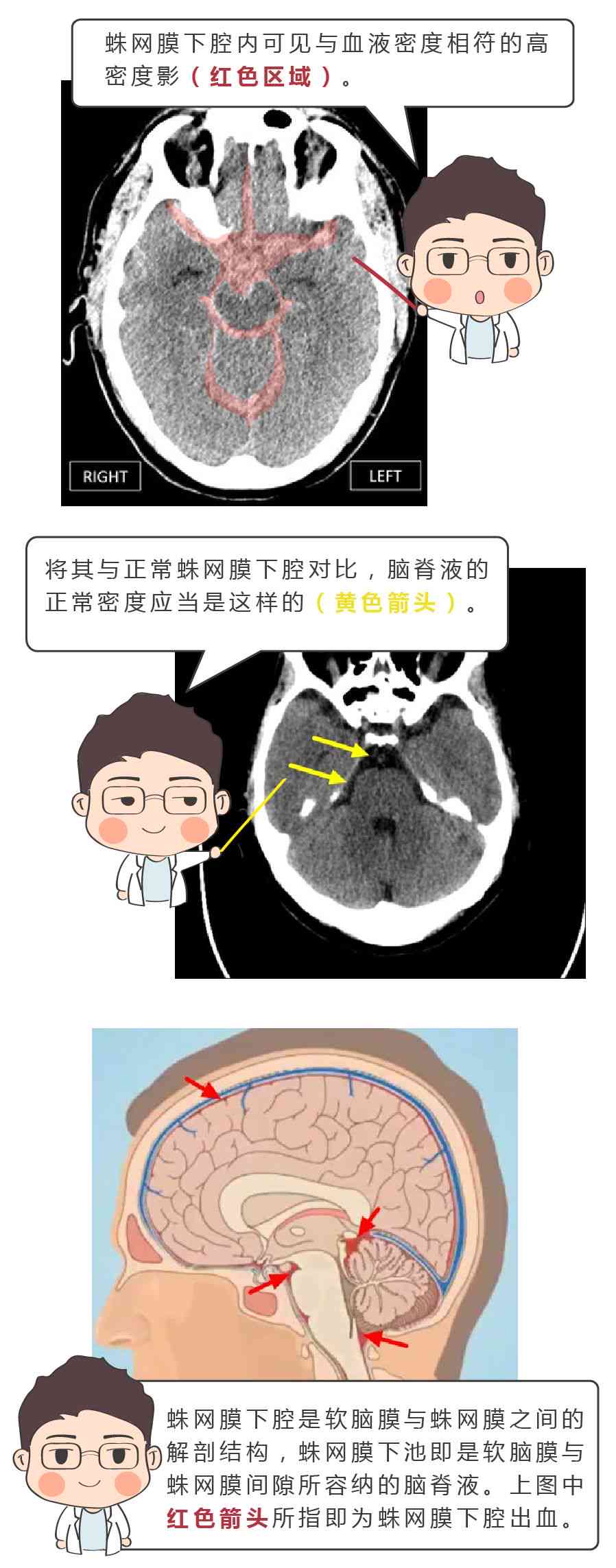 蛛网膜出血可以认定工伤吗