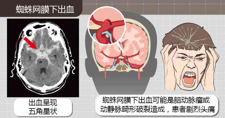 蛛网膜出血可以认定工伤吗