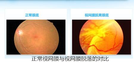 视网膜脱离可以认定工伤吗