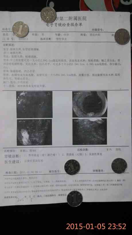 胃溃疡ai期报告