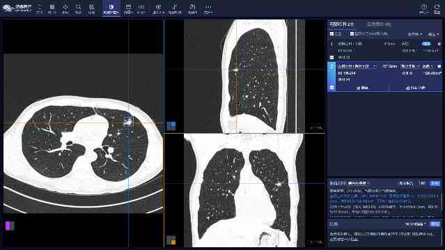 多发肺结节ai智能诊断报告解读