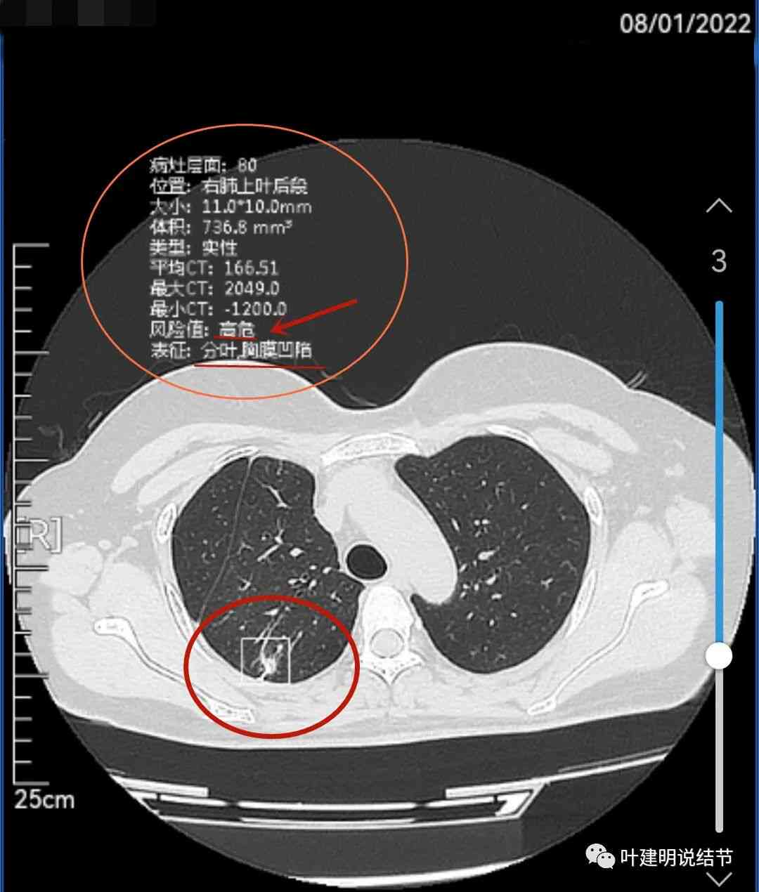 多发肺结节ai智能诊断报告解读