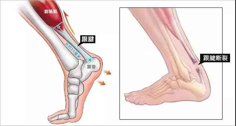 跟腱断裂怎么认定工伤