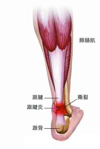 跟腱断裂怎么认定工伤