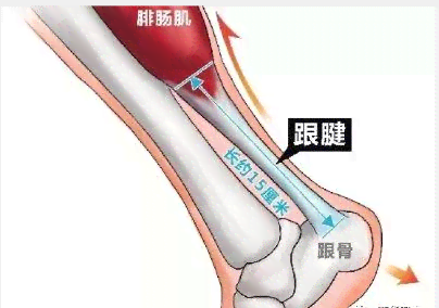 跟腱断裂怎么认定工伤