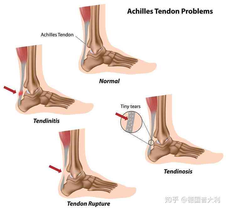 跟腱断裂能认定工伤吗