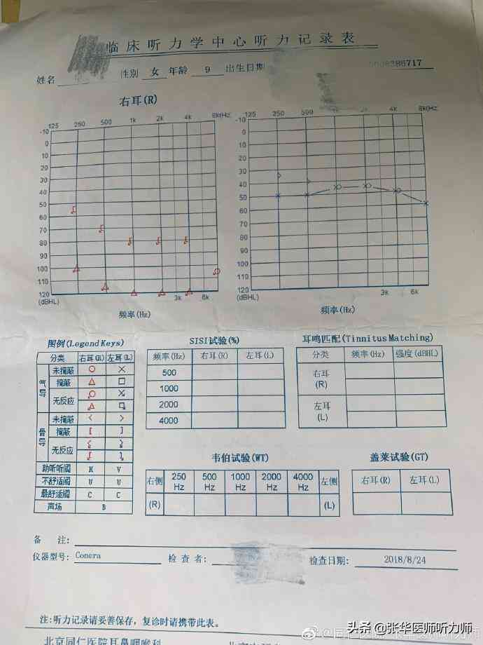 纯音听阈报告上的AI是什么