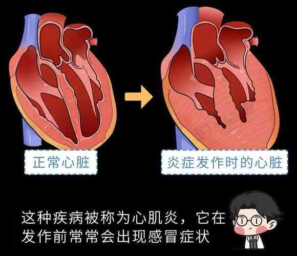 重症心肌炎可以认定工伤吗