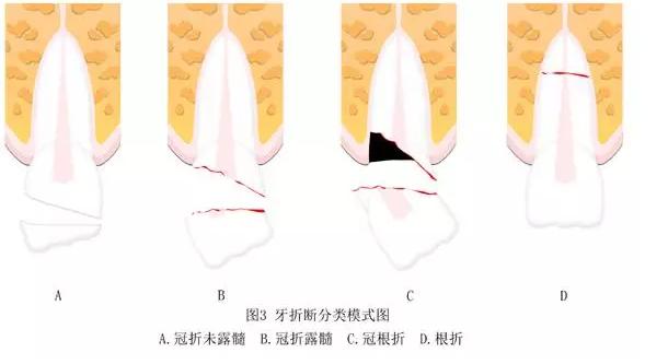 门牙折断怎么认定工伤事故