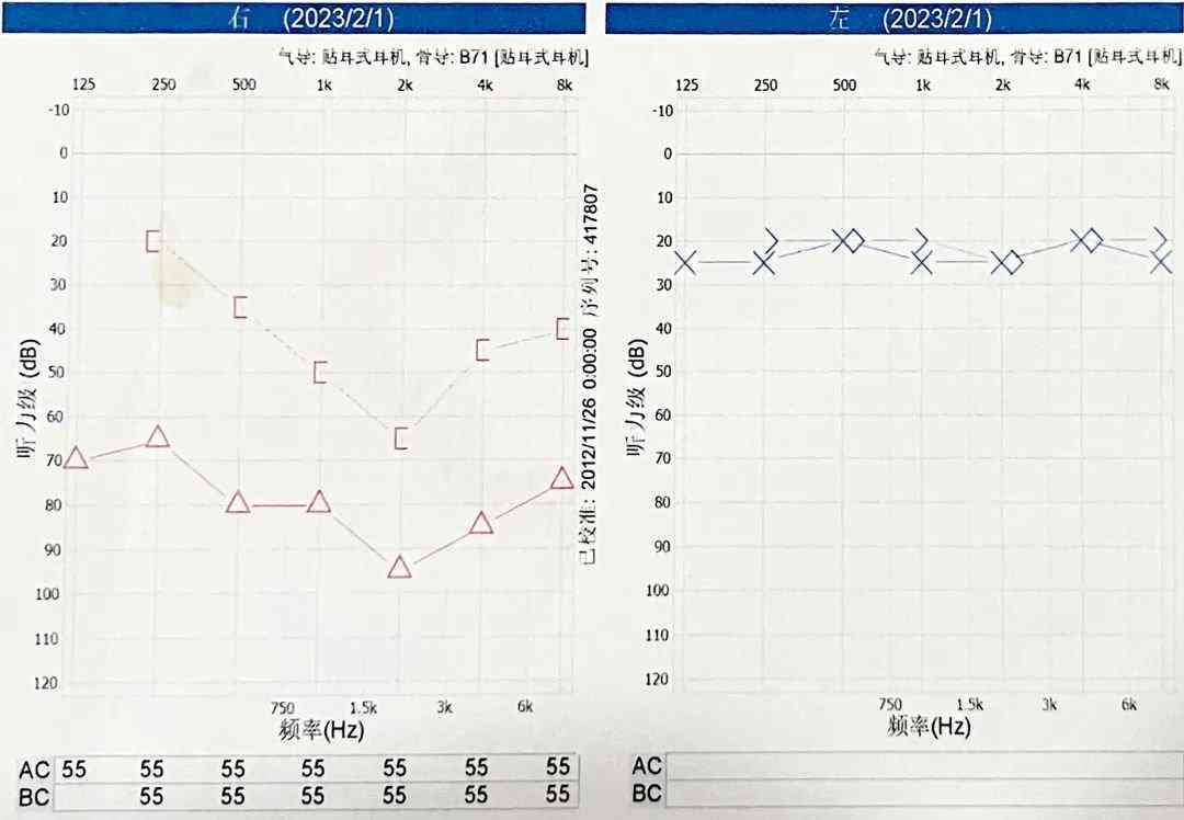 纯音测听报告中AI是什么