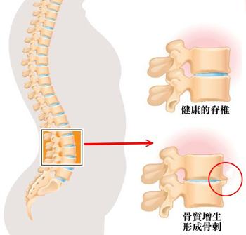 骨质增生能认定工伤