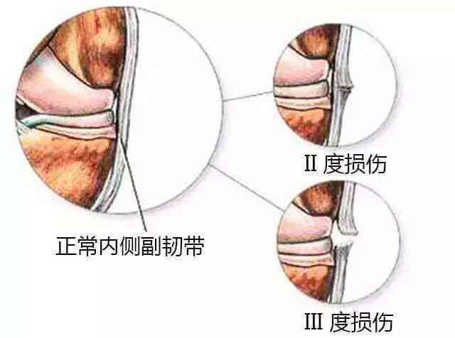 骶髂关节扭伤能认定工伤吗