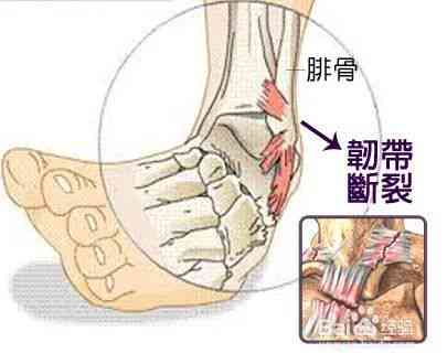 骶髂关节扭伤能认定工伤吗