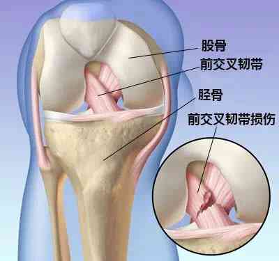 髌韧带断裂重建认定工伤